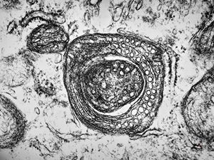 M,1y. | unusually cup-shaped mitochondria - plexus papilloma M,1y. | unusually cup-shaped mitochondria - plexus papilloma